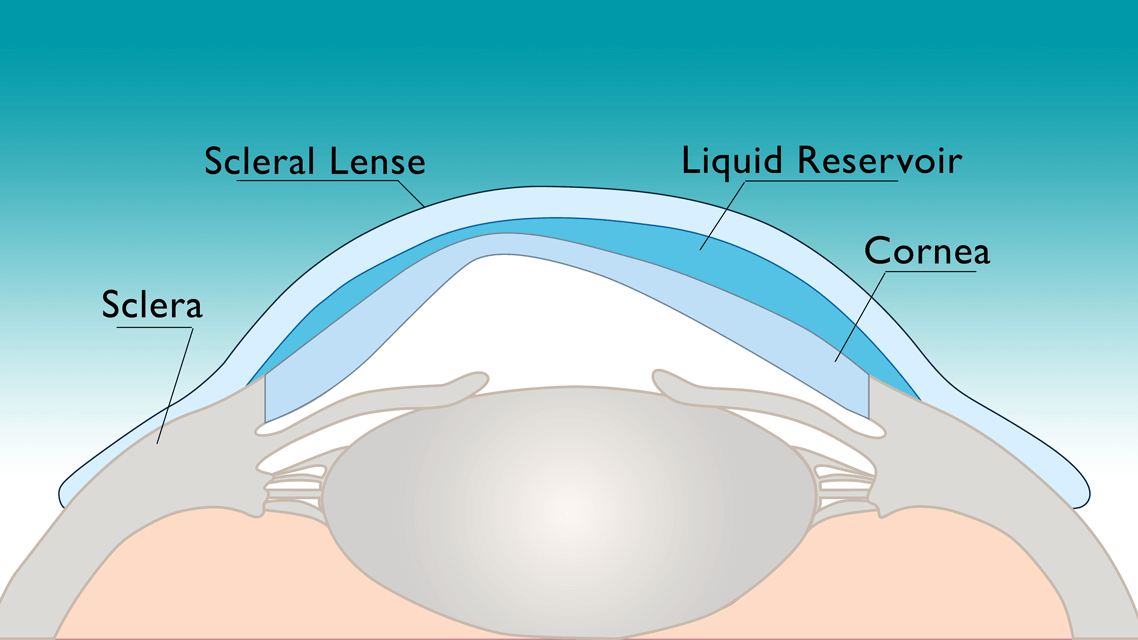 Scleral Lens over top of cornea