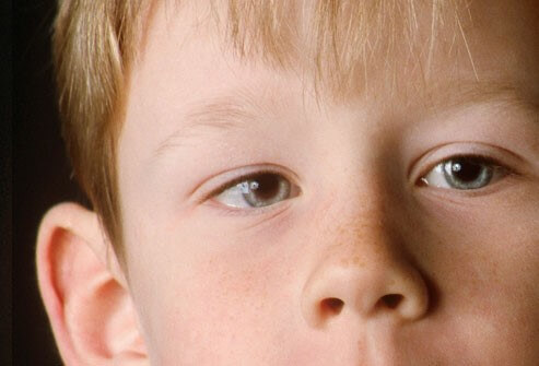 A child showing signs and symptoms of having lazy eye.