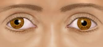 Illustration of Lazy Eye syndrome treatable at Looking Glass Optical
