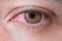 Pink Eye