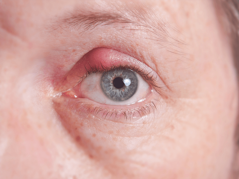 stye of the eye