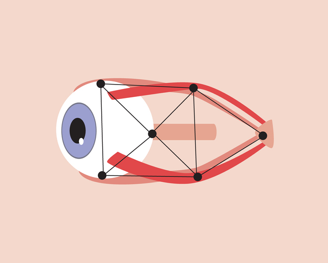 Optic Atrophy - Eye Model