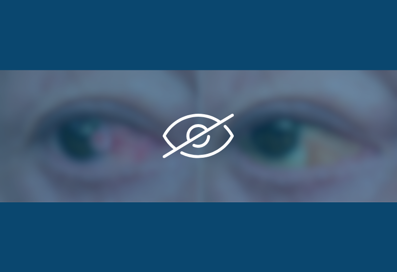 Pterygium (Surfer's Eye